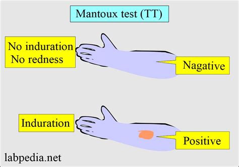 mt test positive images|How to Read a Tuberculosis Skin Test: 9 Steps (with .
